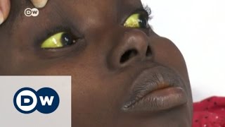 Yellow fever epidemic spreads in Angola  DW News [upl. by Nylesoy341]