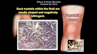 Elbow amp Knee Bursitis Caused By Gout  Everything You Need To Know  Dr Nabil Ebraheim [upl. by Sirak]