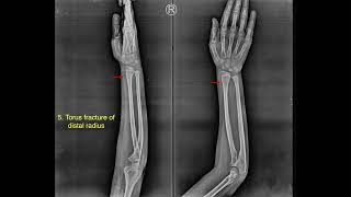 Torus Fracture Distal Radius XRay [upl. by Hurley]