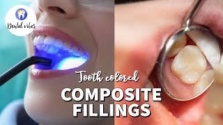 Composite Fillings  Composite filling procedure  Composite bonding to the tooth [upl. by Gensmer]