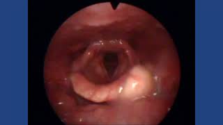 Epiglottic Cyst [upl. by Tennies711]