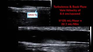 AVA19 Moureau Foor Large Vein High Velocity Hemodilution Case Study 5 [upl. by Scarito]