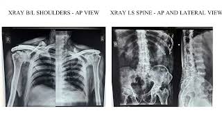 A Case of Ochronosis with Severe Bilateral Osteoarthritis Knee [upl. by Yarrum]