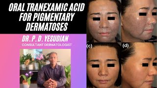 Oral Tranexamic acid for pigmentation [upl. by Owen]