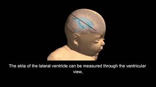 Normal Fetal Head Anatomy and Common Malformations [upl. by Rehm]