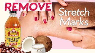 Stretch Marks and how to get rid of them [upl. by Nuris787]