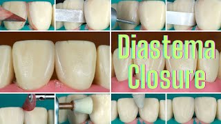 Midline Diastema Closure Photo Series Tutorial [upl. by Nosdrahcir]