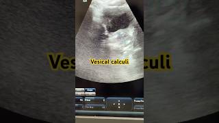 Vesical Calculi Cystoliths videos reels urinarybladder stones calculus cystitis ultrasound [upl. by Suanne509]