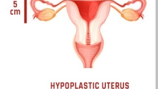 Meaning of Hypoplastic uterusits causes and symptoms [upl. by Ardnwahsal335]