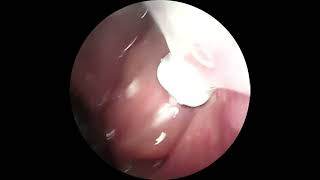 AMAZING TONSIL STONE REMOVAL POP tonsil satisfyingvideo tonsils pimplepopping body health [upl. by Santoro]