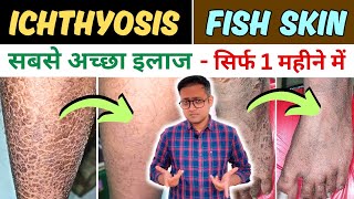 Fish skin  Ichthyosis vulgaris  Xlinked ichthyosis  Treatment  Hindi [upl. by Hut77]