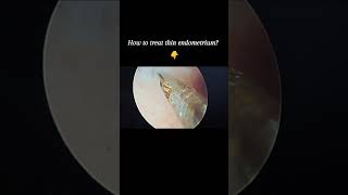 Chronic endometritis endometriosis fertility infection pregnancy uterus hysteroscopy [upl. by Tibbitts]