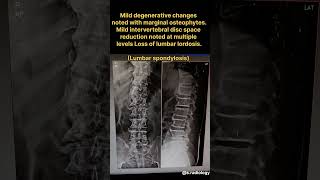 X RAY OF LUMBER SPINE AP amp LAT FINDINGS [upl. by Hairim]