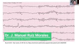 Fibrilación ventricular ENARM [upl. by Esele]