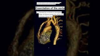 Coarctation of the aorta [upl. by Aeet]