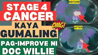 Stage 4 Cancer Kaya Pa Gumaling By Doc Willie Ong [upl. by Aitnahc]