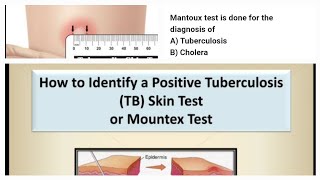 Mantoux test readingmantoux interpretation mantoux testtb skin test indurationTuberculosis [upl. by Ulick]