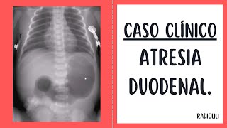 Caso Clínico 92 Atresia duodenal [upl. by Enairda619]