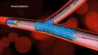 Main Branch Bifurcation Stent quotPROVISIONALquot by Advanced Bifurcation Systems [upl. by Azaria653]