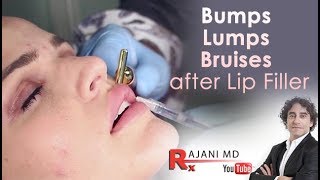 Bumps Lumps Swelling and Bruising after lip FillersDr Rajani [upl. by Nnylirret]