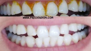 HOW TO GET SUPER WHITE TEETH INSTANTLY  Baking Soda Lime Juice amp Iodised Salt [upl. by Rabma]