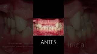 Implantes dentales  Antes y después [upl. by Oniratac]