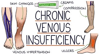 Understanding Chronic Venous Insufficiency [upl. by Corinna]