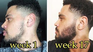 My Minoxidil Beard Journey  Week 17  Pre Minox Photos [upl. by Edras]