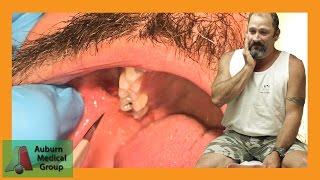 PAINFUL DENTAL ABSCESS DRAINED  Auburn Medical Group [upl. by Zul]