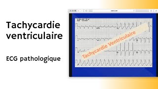 Tachycardie ventriculaire  ECG pathologique  arythmie [upl. by Coriss]