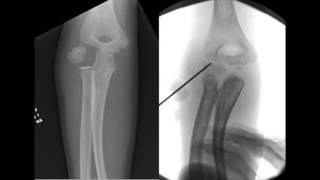 Percutaneous Screw Fixation of Lateral Condylar Humeral Fractures [upl. by Lowrie]