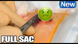 Mr Gumbys Epidermoid Cyst Removal New Full Sac with Dissection [upl. by Aikam]