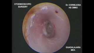 EXPLORACIÓN ENDOSCÓPICA DE MEMBRANA TIMPÁNICA PERFORADA Dr Cornejosa [upl. by Zigmund113]