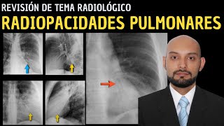 Revisión de Tema 88 Radiopacidades pulmonares [upl. by Alaster]