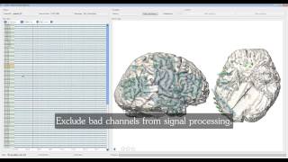 cortiQ  rapid cortical mapping [upl. by Abdulla]