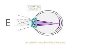 How does MiSight work [upl. by Ginger]