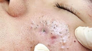 Big Cystic Acne Blackheads Extraction Blackheads amp Milia Whiteheads Removal Pimple Popping  4517 [upl. by Waligore18]