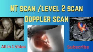 NT scan level 2 scan Doppler scan all in 1 video pregnancy pregnancyscan ultrasound pregnant [upl. by Elyagiba806]