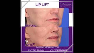 Lip Lift [upl. by Ecitsuj]