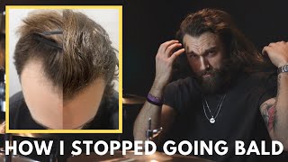 How I Got My Hair Back IN ONE YEAR  Male Pattern Baldness  Christopher Painter [upl. by Ahsenahs]