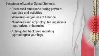 Lumbar Spinal Stenosis  Patient Animation [upl. by Helaine]