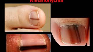 Melanoma Melanonychia  What is it [upl. by Tallula]