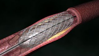 Coronary Artery Angioplasty  Radial Access [upl. by Gittle814]