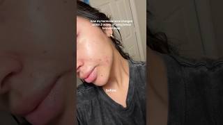 How my hormonal acne changes within 3 weeks of using turmeric soap skincare acnetreatment [upl. by Allenaj]