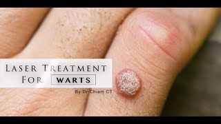 Warts removal with Laser Treatment  Dr Chiam CT [upl. by Cedric]