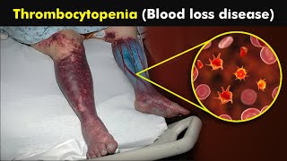 What Causes Low Platelets in our blood  Thrombocytopenia Disease 3D Animation [upl. by Lentha]