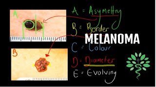 Melanoma  Symptoms signs diagnosis and management [upl. by Fisoi233]