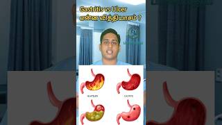 அல்சர் இரைப்பை அழற்சி என்ன வித்தியாசம்Gastritis vs Ulcer differencePangastritisulcer gastritis [upl. by Ydna]