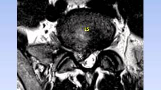 Dr Gillard Lectures on Lumbar Disc Herniation  Protrusion Part II of II [upl. by Yrahcaz]