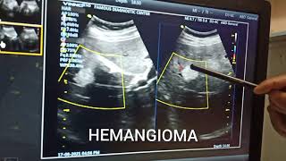 Liver hemangiomaHepatic hemangioma vascular tumor in liver Benign tumor in liver [upl. by Katee318]